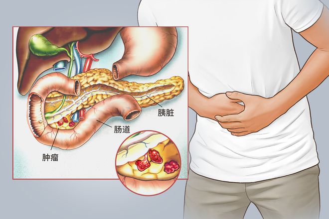 胰腺癌最新疗法，突破与挑战的交汇点探索